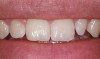 Figure 44  FINAL RESULTS The final restorations are indistinguishable from the surrounding dentition, demonstrating good emergence and re-creation of the interdental papillae.