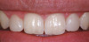 Figure 45  FINAL RESULTS The final restorations are indistinguishable from the surrounding dentition, demonstrating good emergence and re-creation of the interdental papillae.