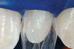 Figure 11  High magnification view of the ideal curvatures created when the Bioclear diastema closure matrices are inserted 1.5 mm subgingivally. The patent-pending diastema closure matrices have a highly exaggerated cervical curvature that is signif