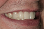 Figure 24  A right side view of the patient’s postoperative smile.