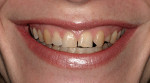 Figure 1  A view of the patient’s smile. There is no disease, just esthetic problems such as color alterations, shape, and position disorders.