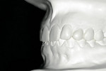 Figure 11  Diagnostic wax-up (mock-up) was done to check details about occlusion and spaces, helping the author determine exactly where to add ceramic and remove teeth.