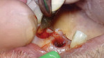 Fig 6. Teeth Nos. 8 and 9 were extracted in an atraumatic flapless manner.