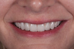 Fig 16. Final smile, frontal view. Note the improved papillary position and invisible pink ceramic-to-tissue interface in the smile.