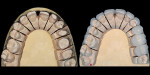 Figure 14  The preparations were conservative and kept in enamel where possible. Notice the slice preparations in the diastema and aggressive preparation of the distal of the cuspids to make proportions more like laterals.