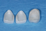 Figure 15  Zirconia veneers were made and character porcelain added only to the outer surface. The ZrO2 inner surface is un-etchable.