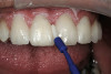 Figure 13  Dual B splint covering all teeth, with anterior midpoint contact.