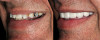 Figure 1  Replacement of a missing tooth has long been a treatment objective to improve oral health and function.