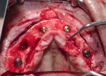 Fig 4. Surgery on the upper arch, which included placement of four implants and removal of one root fragment at tooth No. 5.