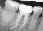 Figure 2  Healing at the apex after re-treatment on tooth No. 30.