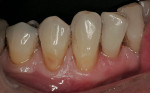 Figure 5  Exposed dentin from an abfraction lesion on teeth Nos. 27 and 28.