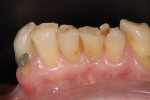 Figure 5  Retained mandibular anterior teeth appear heavily worn and broken down.