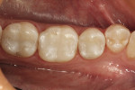 Figure 2  Postoperative photograph of three Class I composite resin restorations using a microhybrid composite.