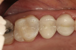 Figure 4  The final results are a clinically excellent Class II restoration.