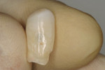 Figure 6  The patient’s natural tooth was hallowed out in order to be used as a provisional restoration.