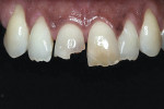 Heavily carious central incisor with pronounced natural characterizations.