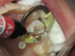 Figure 10  F00 placed in the mesial aspect of the preparation.