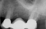 Fig 3. Case 1. The 6-month follow-up periapical radiograph showed the completed root canal treatment on tooth No. 14.