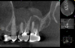 Fig 6. Case 2. Preoperative CBCT sagittal view of the buccal roots of the first and second molars showed thickening of the sinus membrane and disruption of the maxillary sinus floor.