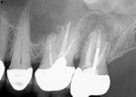Fig 5. Case 2. Preoperative periapical radiograph showed previous root canal treatment on teeth Nos. 14 and 15