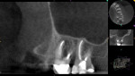 Fig 12. Case 3. The 12-month follow-up CBCT sagittal view of the buccal roots of the first and second molars showed the resolution of the mucous retention cysts.