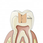 Figure 3  The SonicFill™ system allows a placed to polished restoration in less than 3 minutes in cavities up to 5 mm.
