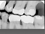 Figure 3  A radiograph shows the precise fit of both crowns, as well as the more typical fit of a traditionally fabricated crown on tooth No. 19.