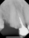 Figure 1  Initial radiograph taken before endodontic therapy and final radiograph taken after cementation and after endodontic therapy was completed. This demonstrates lack of communication between endodontist and restorative dentist.