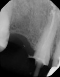 Figure 2  Initial radiograph taken before endodontic therapy and final radiograph taken after cementation and after endodontic therapy was completed. This demonstrates lack of communication between endodontist and restorative dentist.