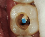 Figure 6  A pre-fabricated fiber post, PeerlessPost, was placed in the distal canal. The post space was created by the endodontist, so no additional dentin removal was required for post placement. Whether additional retention is gained through post p