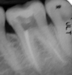 Figure 9  Radiographs before and after post placement. No additional dentin was removed after obturation for preparation of the post space. The endodontist created the post space prior to the patient returning for the restoration.