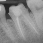 Figure 10  Radiographs before and after post placement. No additional dentin was removed after obturation for preparation of the post space. The endodontist created the post space prior to the patient returning for the restoration.