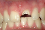 Figure 11  A central incisor with a very wide canal. Due to the size of the canal, the decision to use a cast post and core instead of a pre-fabricated post and core was made.