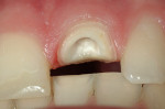 Figure 12  Adequate amount of tooth structure present to obtain the ferrule effect demonstrated before post-and-core fabrication.