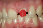 Figure 13  DuraLay (Reliance Dental Mfg Co, <a target=