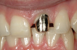 Figure 14  Buccal view of a cast post and core fabricated with gold.