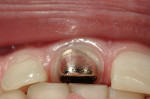 Figure 15  Incisal view of casting demonstrates clean margins and proper occlusal reduction in spite of deep bite. This amount of reduction for composite would have weakened the build-up or caused a sharp angle requiring further incisal reduction.