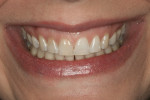 Figure 1  Preoperative smile view 1:2.