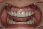 Figure 12  Try-in with Variolink Veneer +1 resulted in slight color variation between teeth Nos. 8 and 9.
