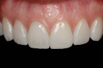 Figure 15  Postoperative view of the final ceramics on teeth Nos. 6 through 11.