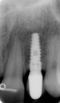 Figure 4  Two-year posttreatment radiograph of BioHorizons Laser-Lok Tapered Internal 3.5-mm platform in site No. 10.