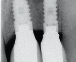 Figure 10  Magnification of a radiograph of two BioHorizons Tapered Internal Implants (42 months after surgical placement and 39 months after restoration) showing crestal stability between two implants, with less than 3 mm of implant-to-implant space