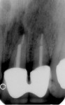 Figure 12  Pretreatment radiograph demonstrating endodontically treated teeth Nos. 9 and 10 with long posts and periapical pathology. Horizontal root fractures noted clinically were not evident on the radiograph.
