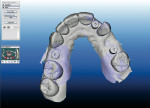 Figure 1  Occlusal view of digital impressions of BellaTek™ Healing Abutments supported by dental implants, taken with a Cadent iTero™ Intraoral Scanner.