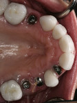 Figure 3  Occlusal view of definitive BellaTek™ Abutments in place.