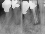 Figure 3  A before-and-after example of excellent obturations of root canal systems.