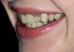 Figure 4  A lateral smile view was used to show the patient the number of teeth that treatment was needed on to blend the enhancements naturally. In this photograph, five teeth from the midline are clearly visible in a natural smile.