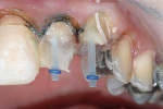 Figure 17  After endodontic treatment, the teeth were restored using esthetic fiber-composite posts. The build-up was completed with a dual-cure composite build-up material