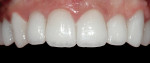 Figure 21  Three weeks after cementation, healing was excellent and tissues were very receptive to the gingival recontouring.