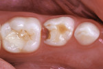 Fractured resin-modified glass-ionomer restoration in mandibular left primary first molar with new caries infection.